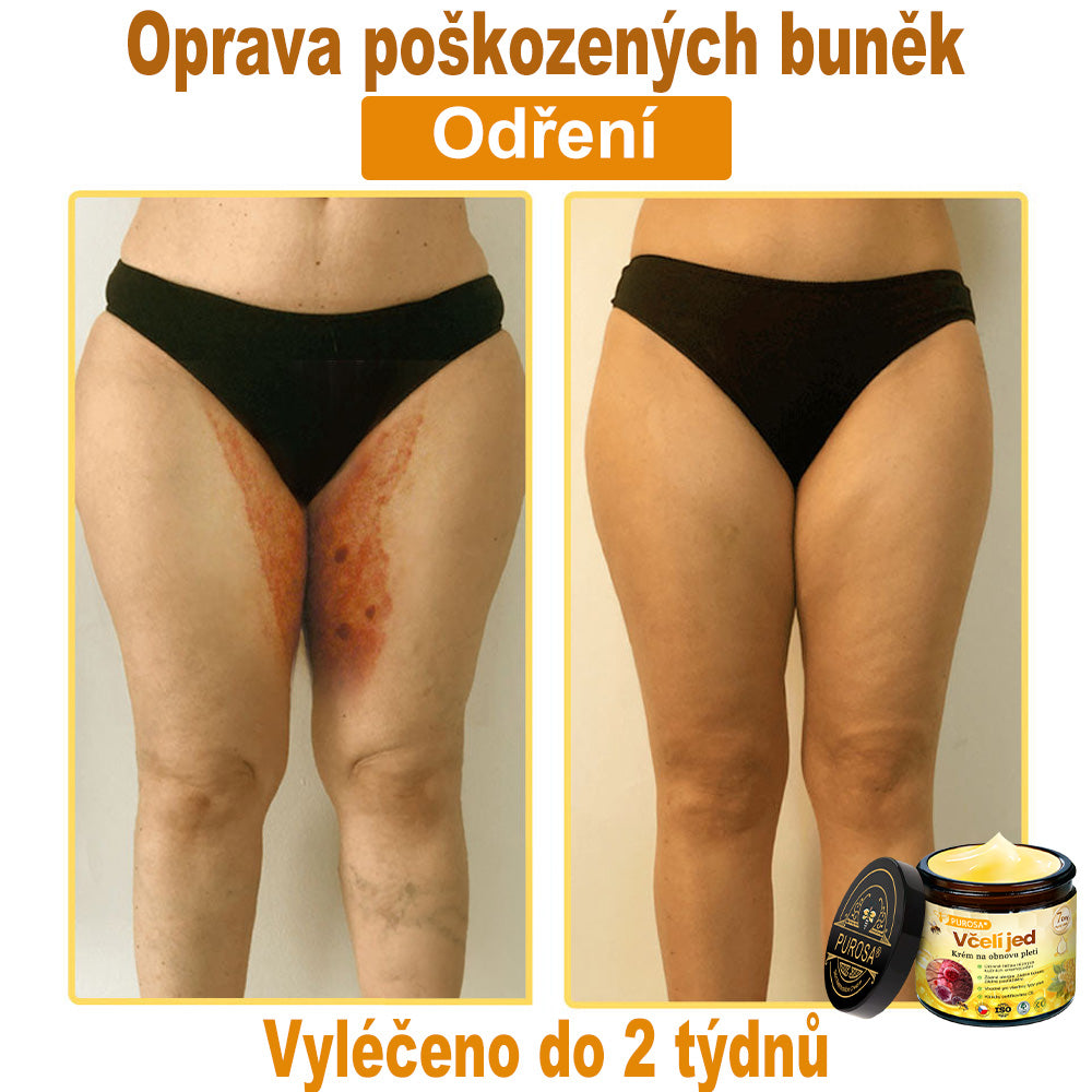 🐝PUROSA® Obnovující krém s včelím jedem|✅Kompletní řešení pro odolné kožní problémy, jako je stárnutí, ekzém, jizvy a lupénka