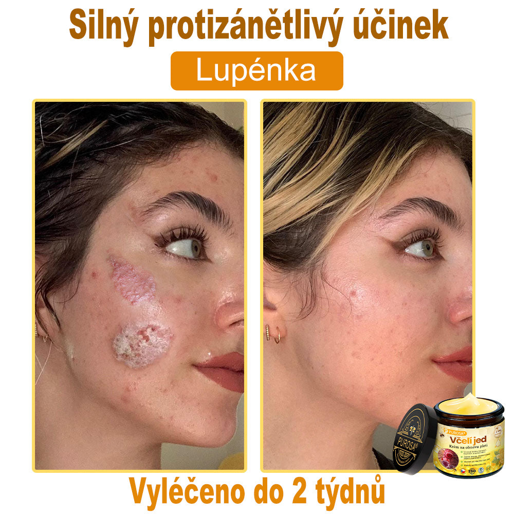 🐝PUROSA® Obnovující krém s včelím jedem|✅Kompletní řešení pro odolné kožní problémy, jako je stárnutí, ekzém, jizvy a lupénka