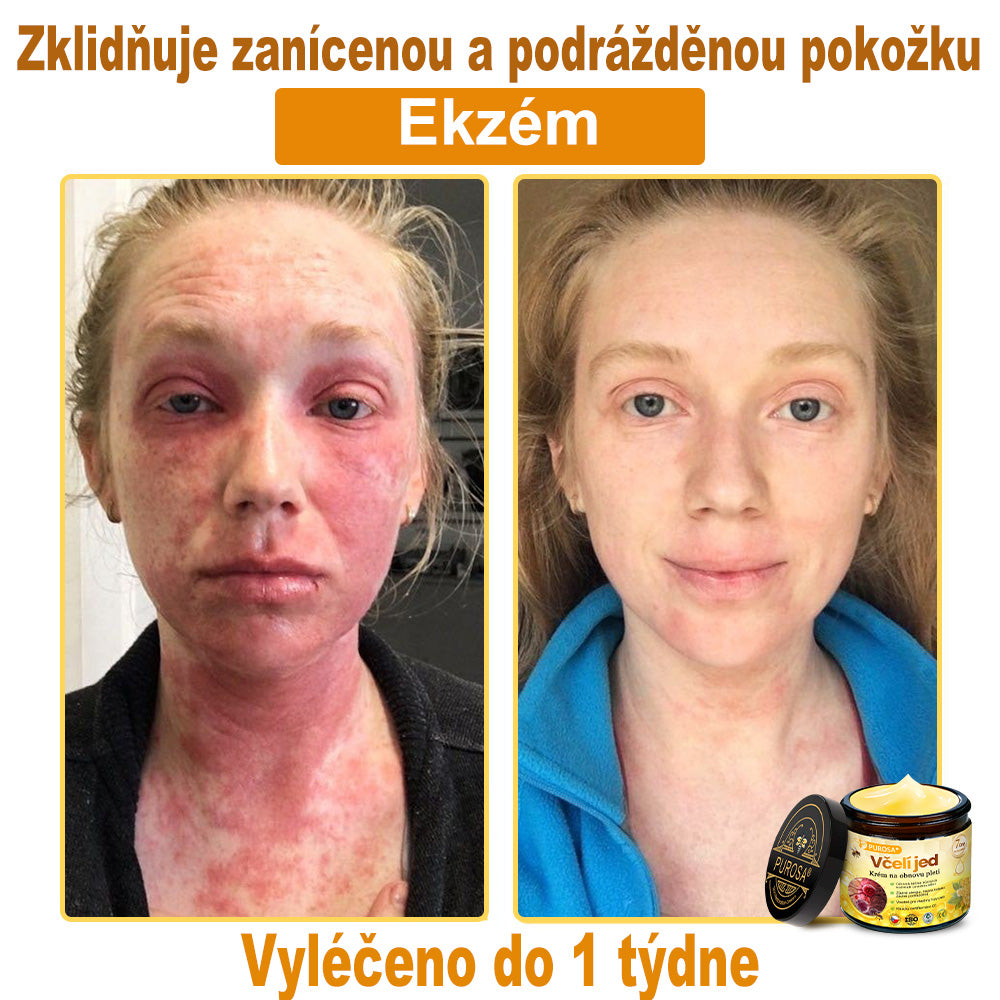 🐝PUROSA® Obnovující krém s včelím jedem|✅Kompletní řešení pro odolné kožní problémy, jako je stárnutí, ekzém, jizvy a lupénka