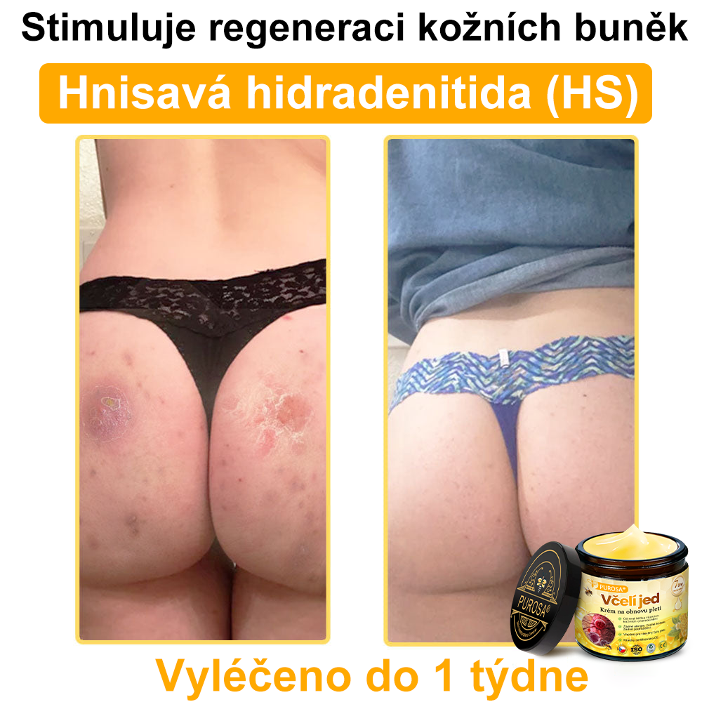 🐝PUROSA® Obnovující krém s včelím jedem|✅Kompletní řešení pro odolné kožní problémy, jako je stárnutí, ekzém, jizvy a lupénka